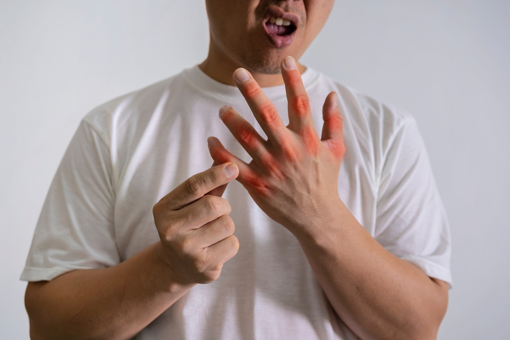 Halamang Gamot Para Sa Gout Na Pwedeng Subukan, Alamin Dito