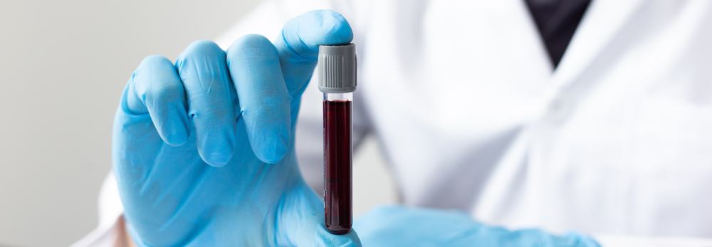 Marburg Virus Disease, Mas Mapanganib Nga Ba Ito Kaysa Sa Ebola?