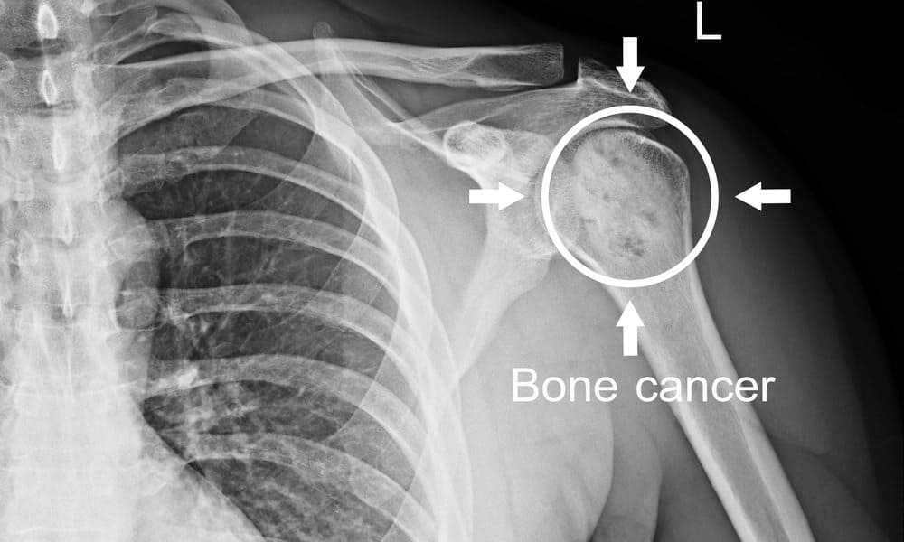 Alamin: Anu-ano Ang Sintomas Ng Kanser Sa Buto?