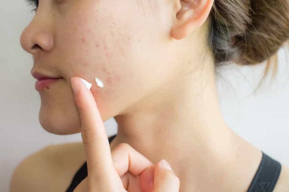 Common Acne Medications: How They Work for You