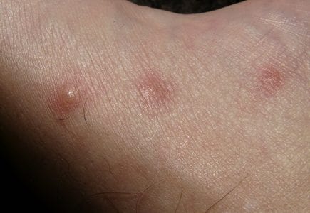 Bakit Nga Ba Nagkakaroon Ng Paltos Ang Mga Diabetic?