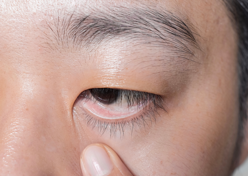 Pagkain Para Sa Anemic: Ano-Ano Ang Mga Dapat Mong Kainin?