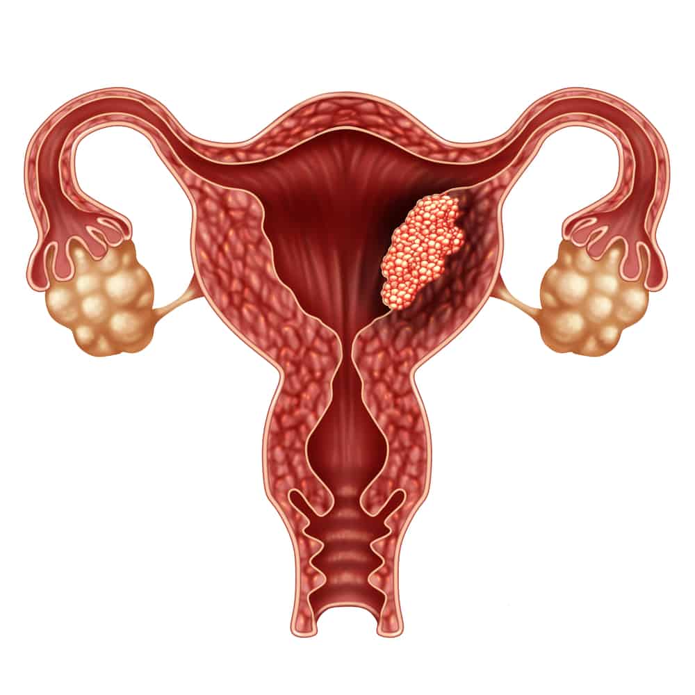 Ano Ang Endometrial Cancer At Paano Ito Ginagamot?