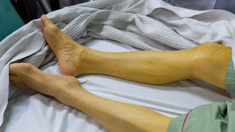 Paninilaw Ng Balat, Anu-Ano Ang Posibleng Dahilan? Alamin Dito