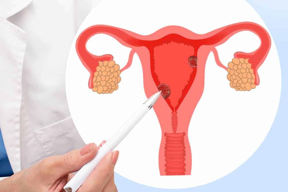 Ano Ang Endometrial Cancer? Heto Ang Dapat Mong Malaman