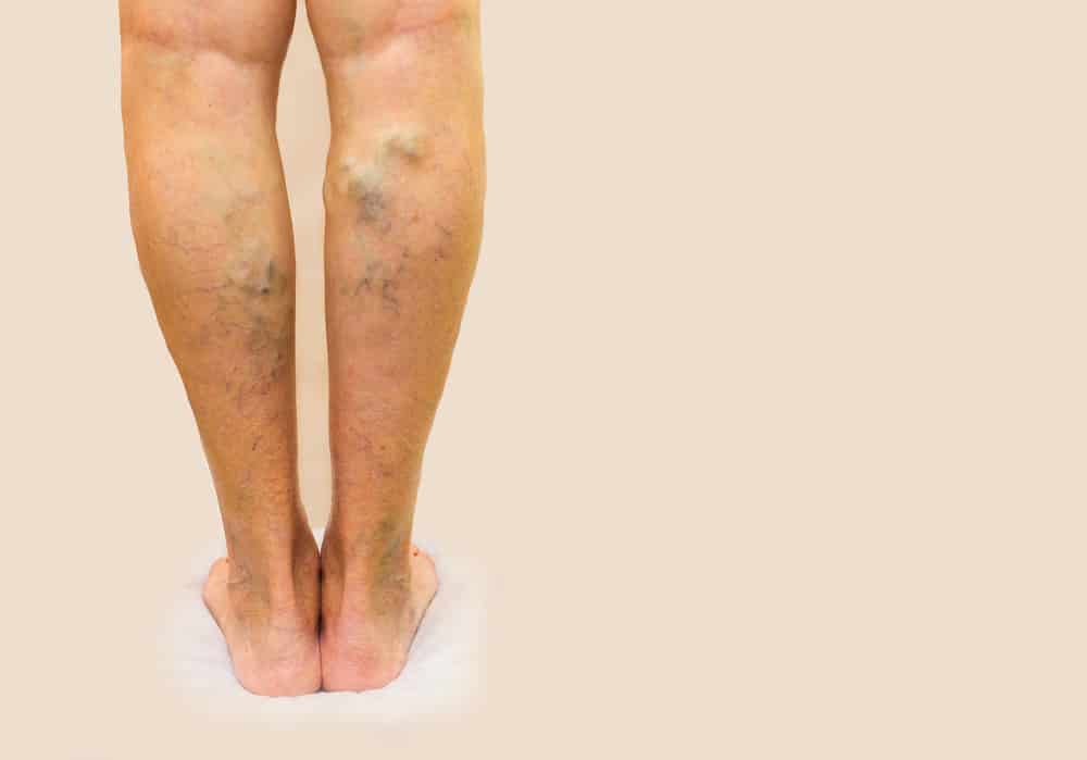 Ano Ang Varicose Veins At Paano Ito Nakakaapekto Sa Kalusugan?