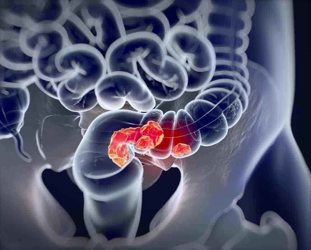 stages-ng-colorectal-cancer