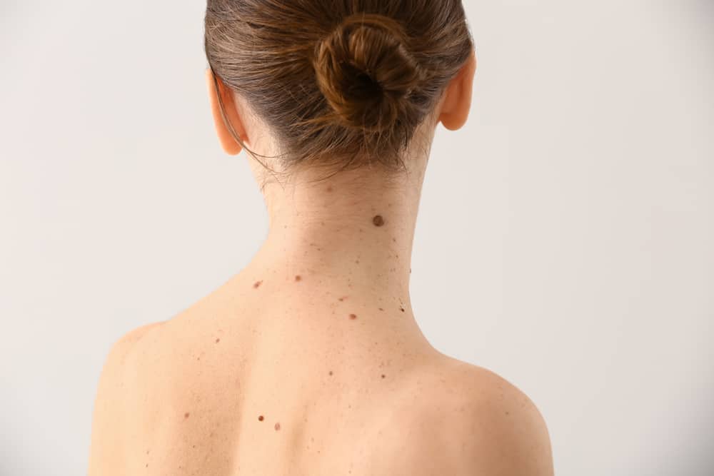 Moles: Here's What You Should Know