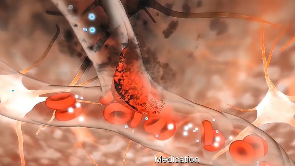 Aneurysms: Are You At Risk?