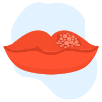 Maaari bang humantong sa Cancer ang Herpes?