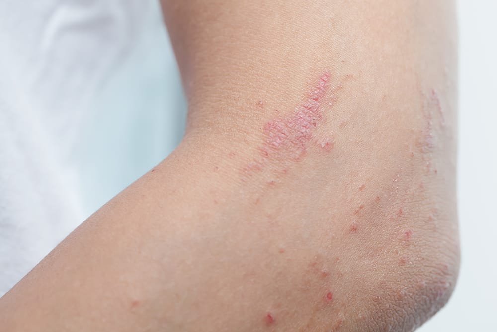 Ano ang Keratosis Pilaris at Paano Ito Gagamutin o Lulunasan?