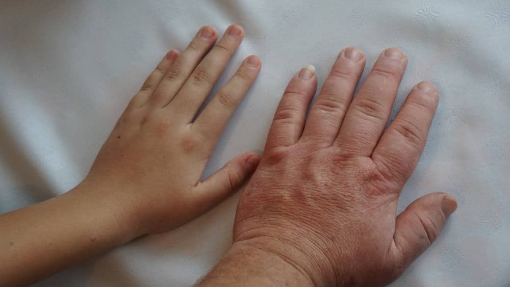 Acromegaly: Kapag May Napakaraming Growth Hormone