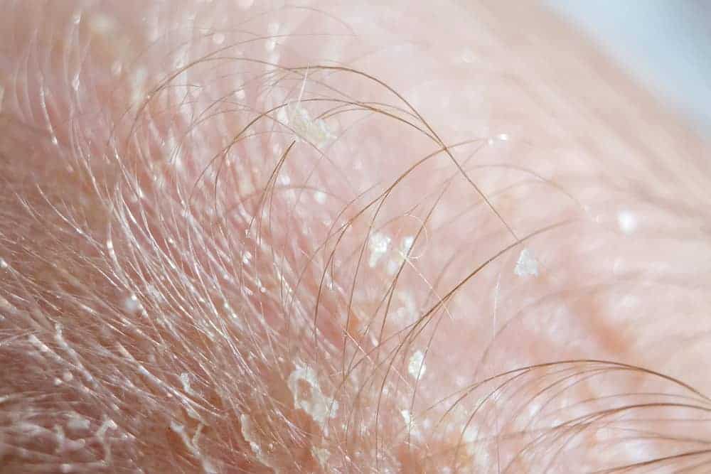 Gamot sa Cradle Cap: Paano Matatanggal ang Ganitong Kondisyon sa mga Infant