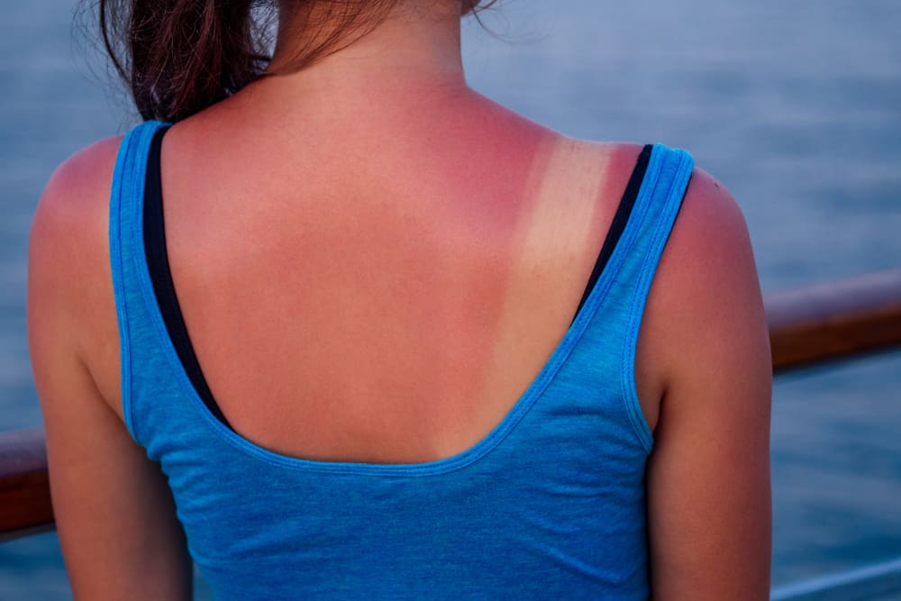 Sunburn: How It Feels Like And How To Treat It