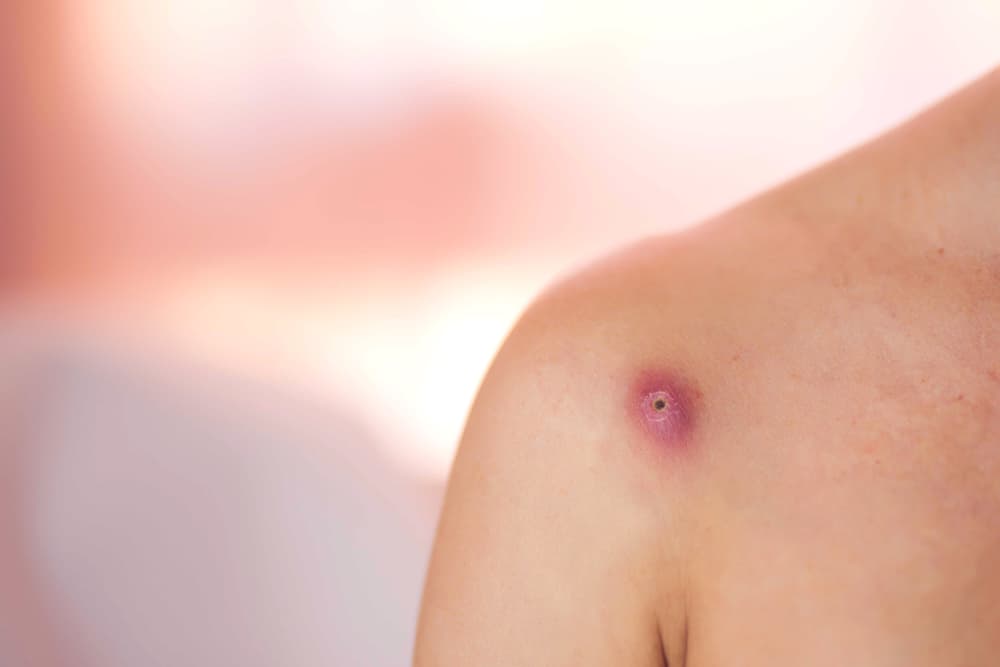 Alamin: Ano ang Flesh-eating Bacteria? (Necrotizing Fasciitis)