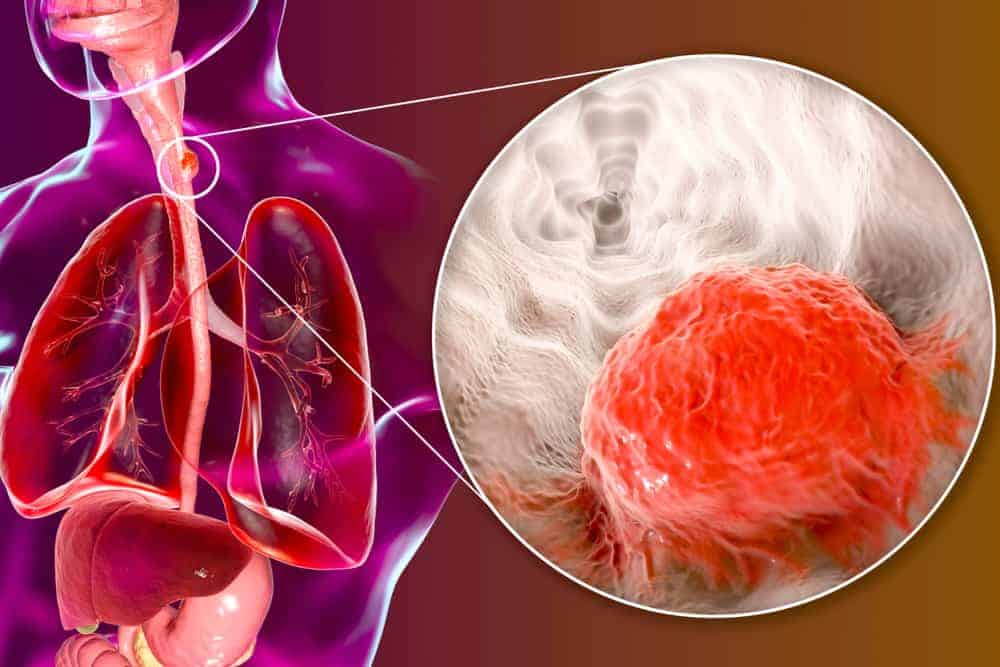 Esophageal Cancer: Mga Senyales At Sintomas