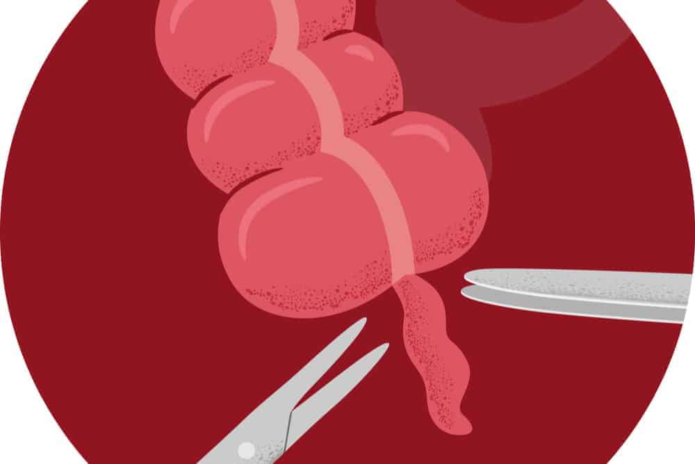 Para Saan Ang Appendectomy? Kailan Ito Kailangan?