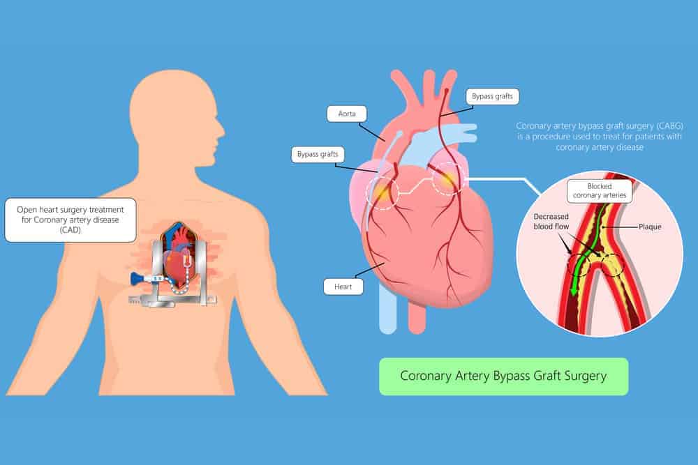 Coronary Artery Bypass Graft: Ano Ito At Paano Ito Ginagawa?