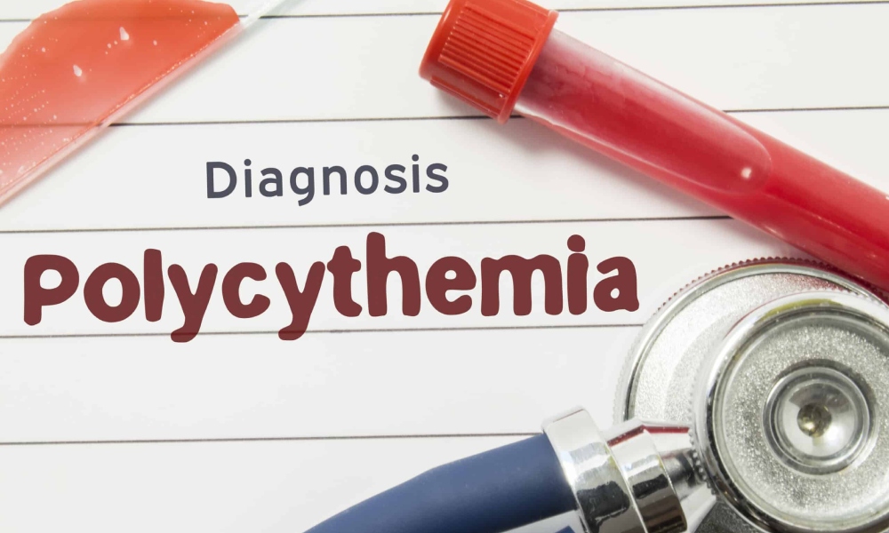 Alamin: Ano ang Sintomas ng Polycythemia Vera?