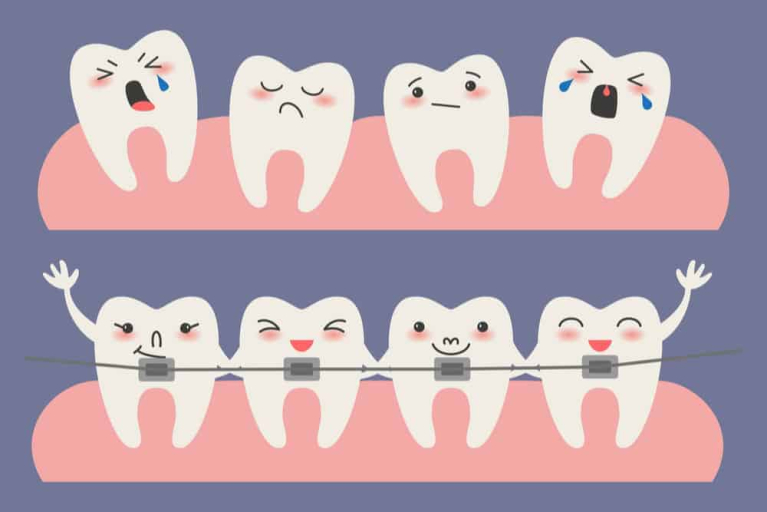 Mga Dapat Malaman Kung MagpapaDental Braces Ka