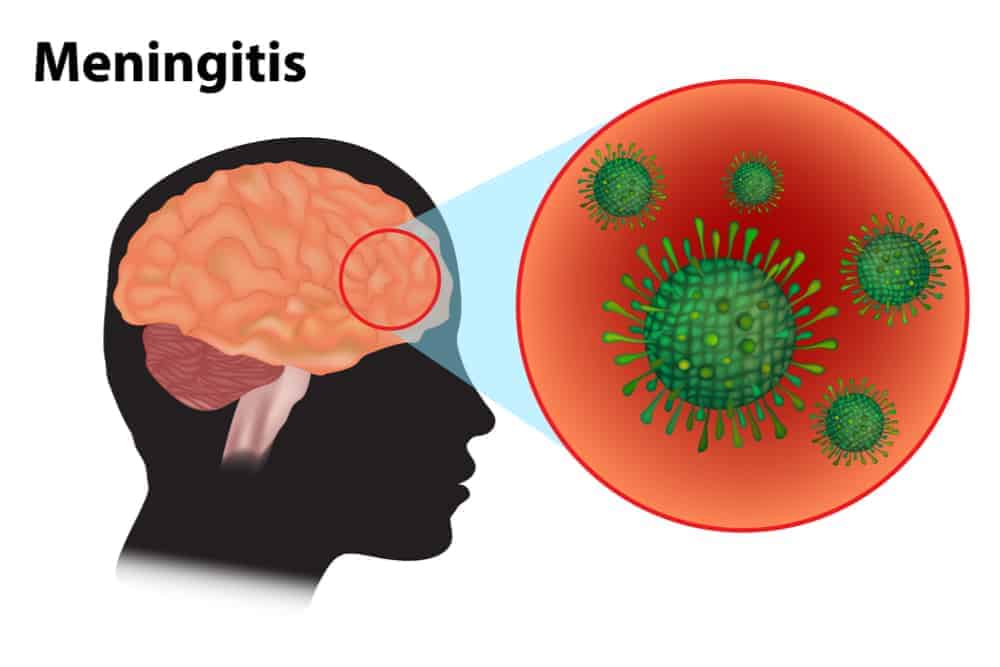 Stages ng TB Meningitis: Kahalagahan ng Maagang Pagtuklas