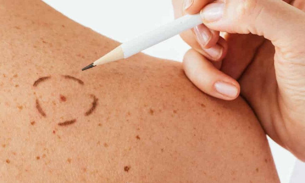 Mangangamba ba ako sa Nunal na ito? Alamin ang mga Uri ng Melanoma