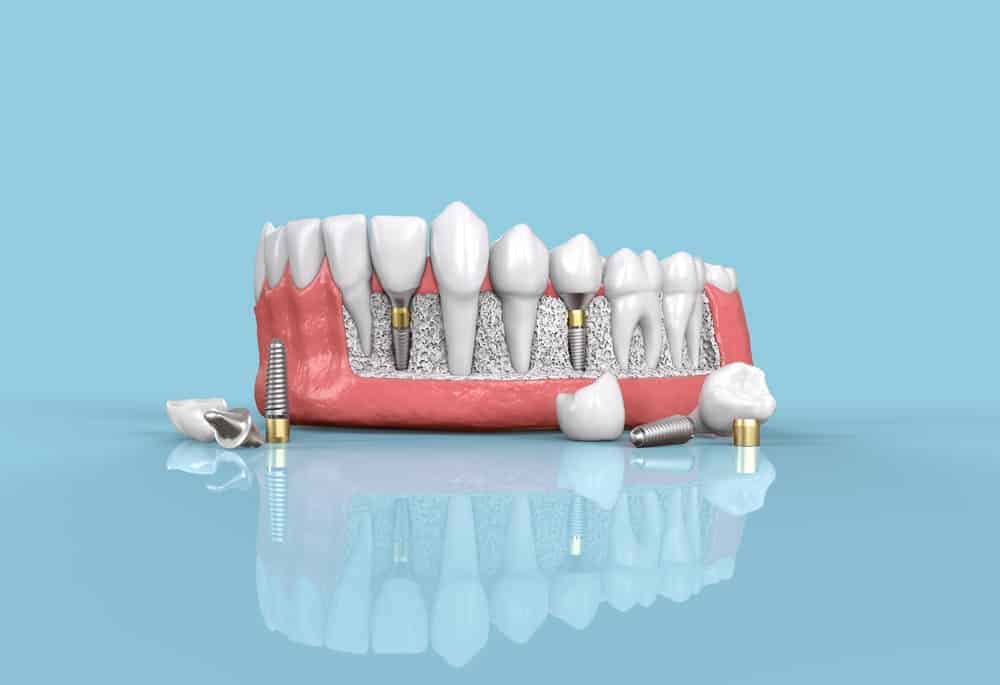 Mga Uri Ng Dental Implant: Alin Ang Tama Para Sa Iyo?