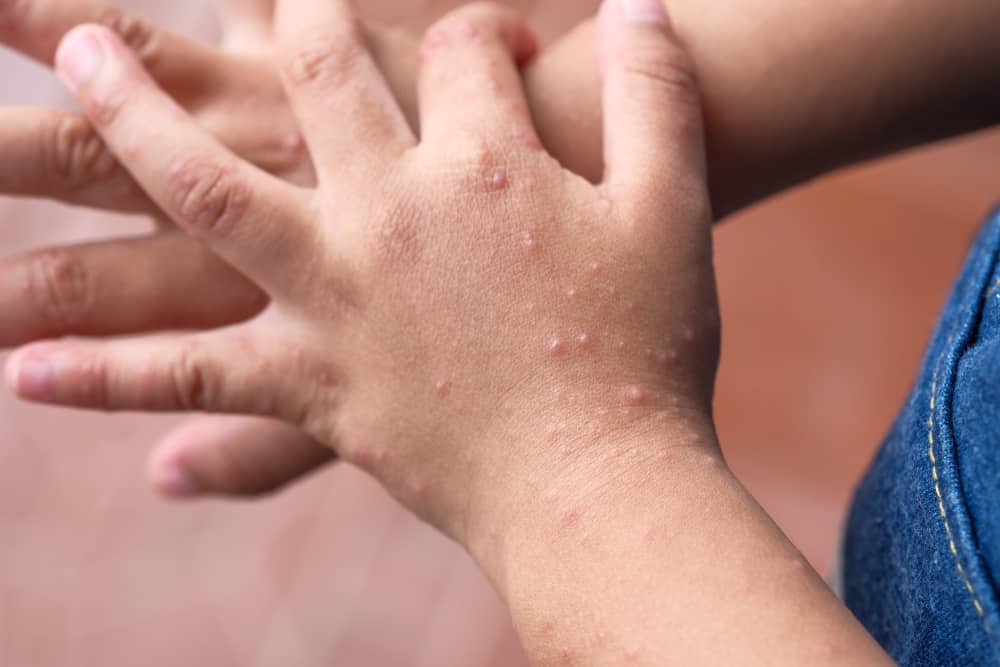 Dapat bang ikabahala ang kaso ng HFMD sa Sarangani? Alamin dito!