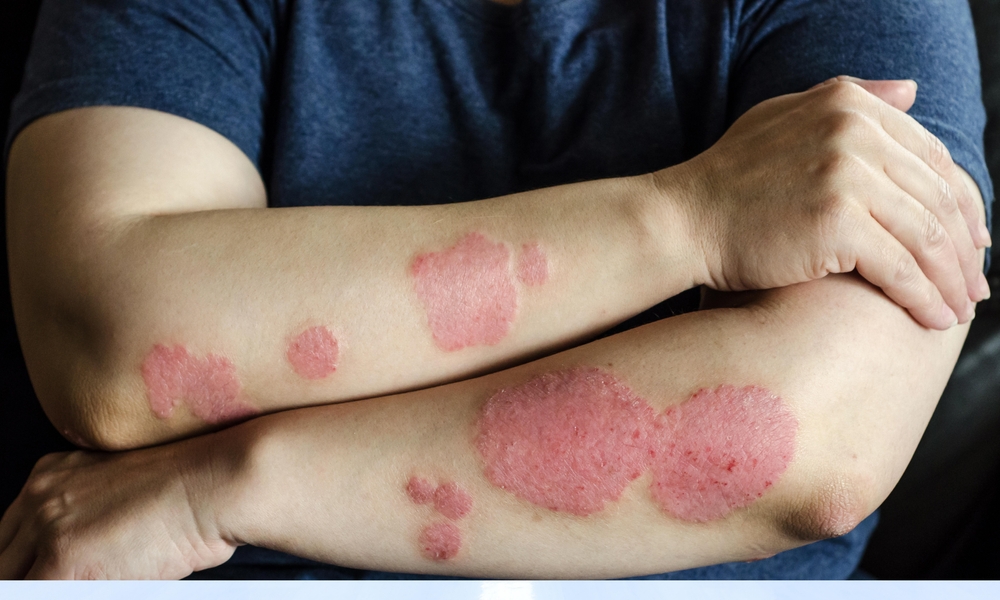 Ano ang Pagkakaiba ng Eczema, Psoriasis, at Dermatitis?