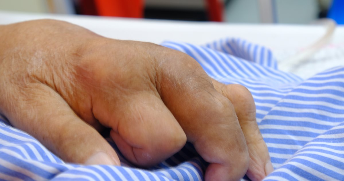 Anu-ano Ang Sintomas Na Mataas Na Pala Ang Iyong Uric Acid?